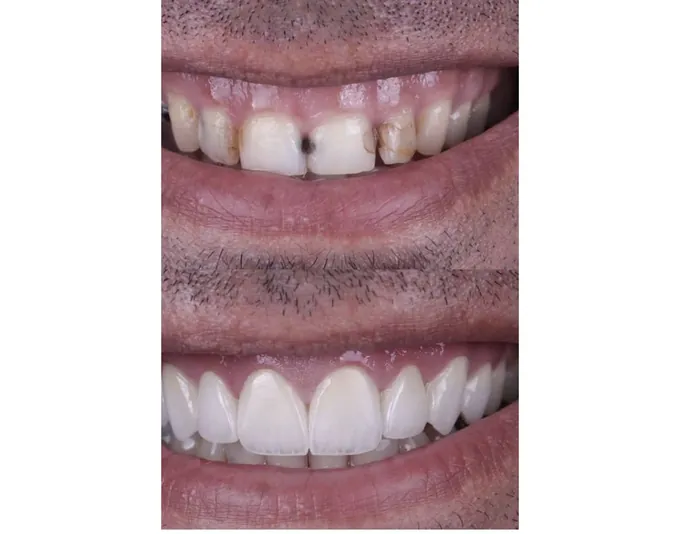 Smile before and after treatment by Dr. Fox