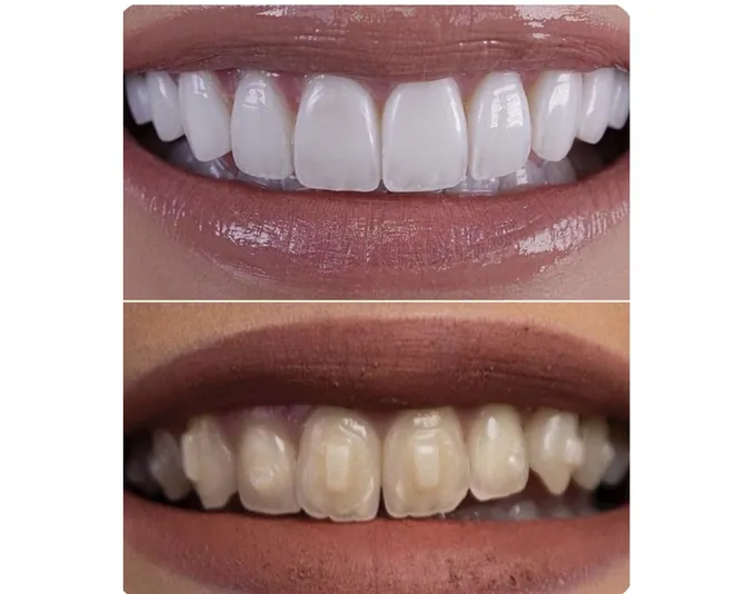 Smile before and after treatment by Dr. Fox