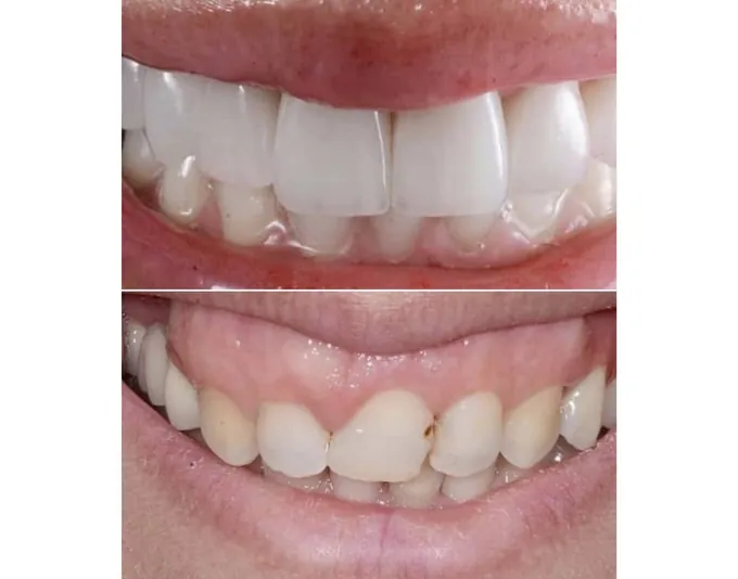 Smile before and after treatment by Dr. Fox