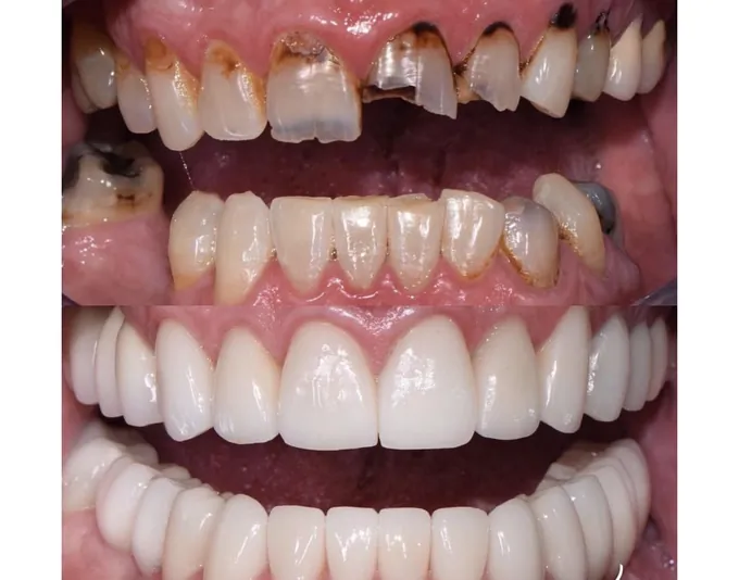 Smile before and after treatment by Dr. Fox