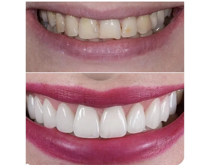 Smile before and after treatment by Dr. Fox